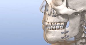 Üst Çene Genişletme Ameliyatı Sonrası