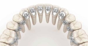 Lingual Ortodonti Tedavisi